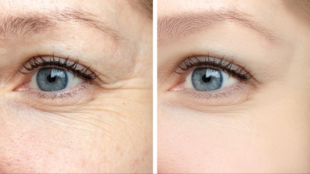 Comparison of before and after Botox treatment showing wrinkle reduction and smoother skin.