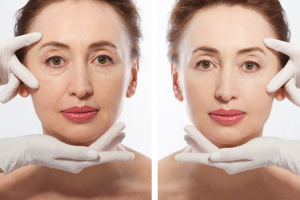 Before and after comparison showing the rejuvenating effects of dermal fillers on a mature woman's skin.