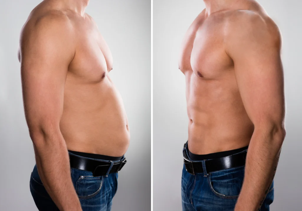 A before-and-after comparison of a sculpted abdomen achieved with CoolSculpting