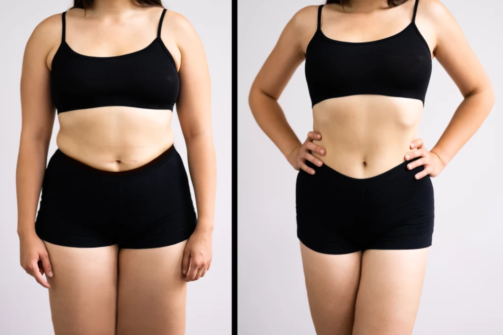 Before and after results of Semaglutide treatment showcasing significant weight loss progress.