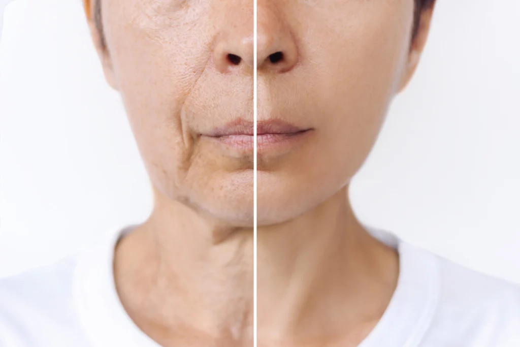 A split image of a face shows dramatic improvements in skin texture and wrinkles after undergoing PRF with microneedling treatment.