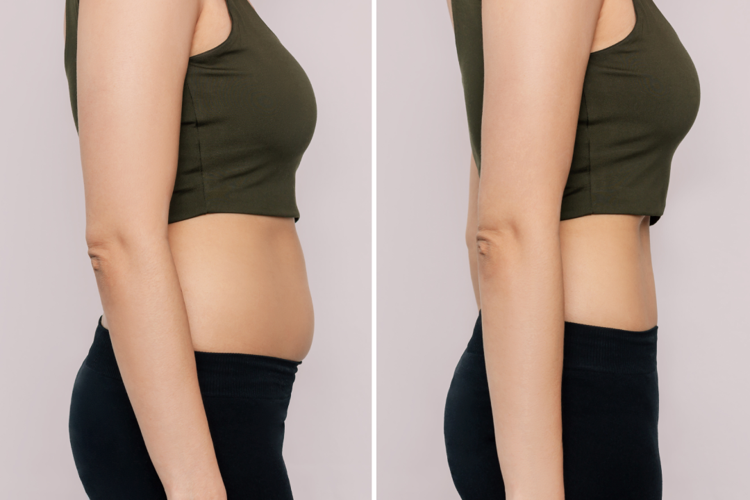 A side-by-side comparison showing a woman’s body before and after CoolSculpting, highlighting reduced abdominal fat.