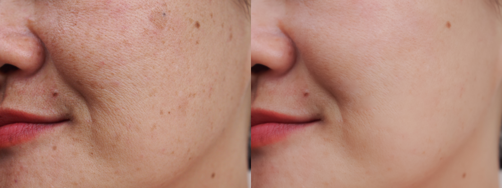 Close-up before and after skin transformation with BBL treatment.
