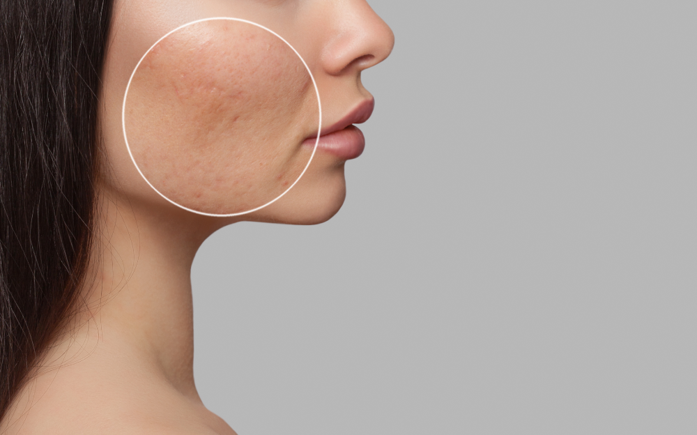 Halo laser treatment for acne scars