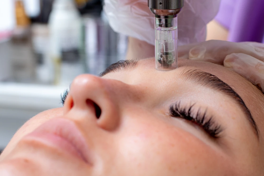 Close-up of microneedling device in use on forehead.