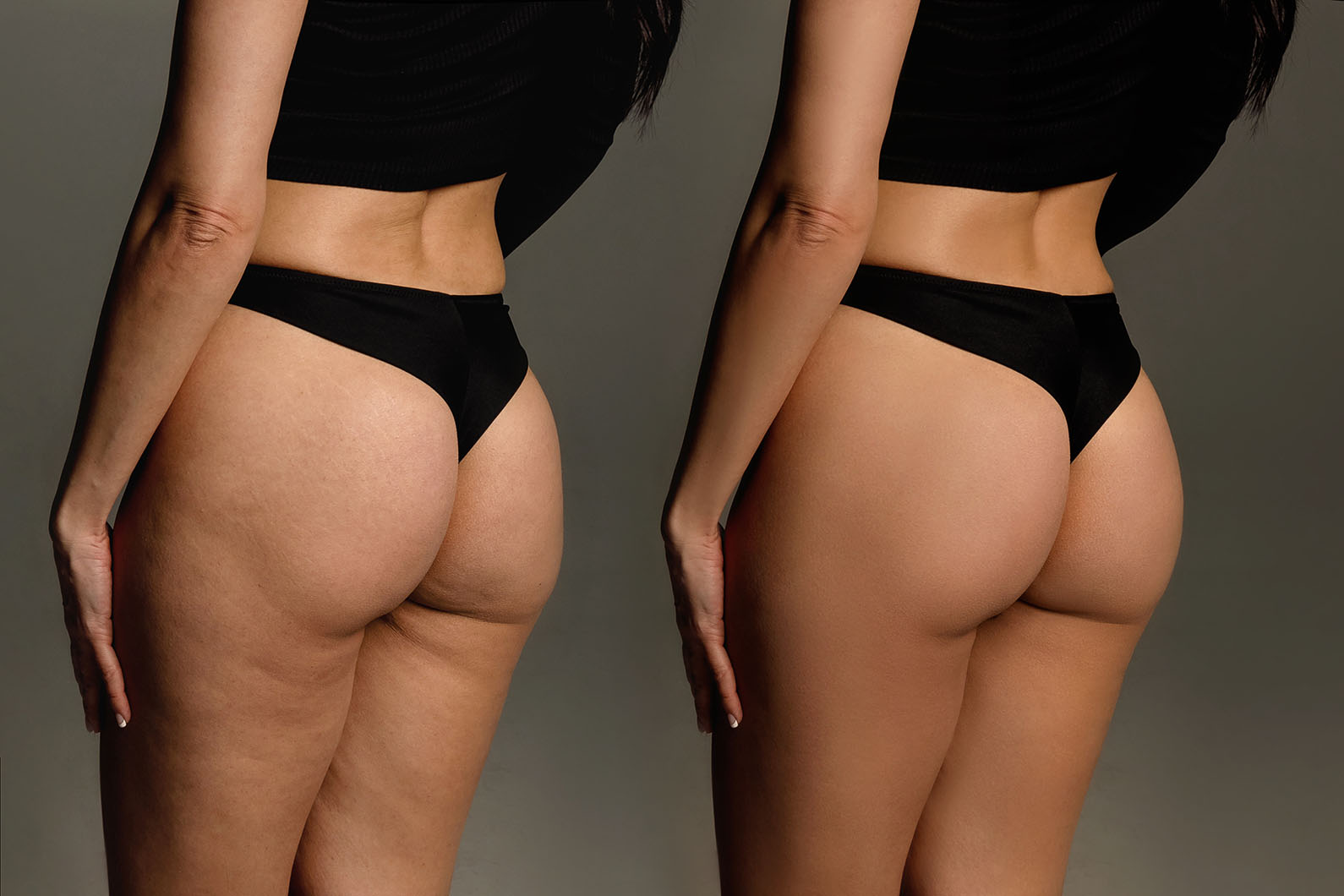 Before and after cellulite reduction with CoolSculpting.