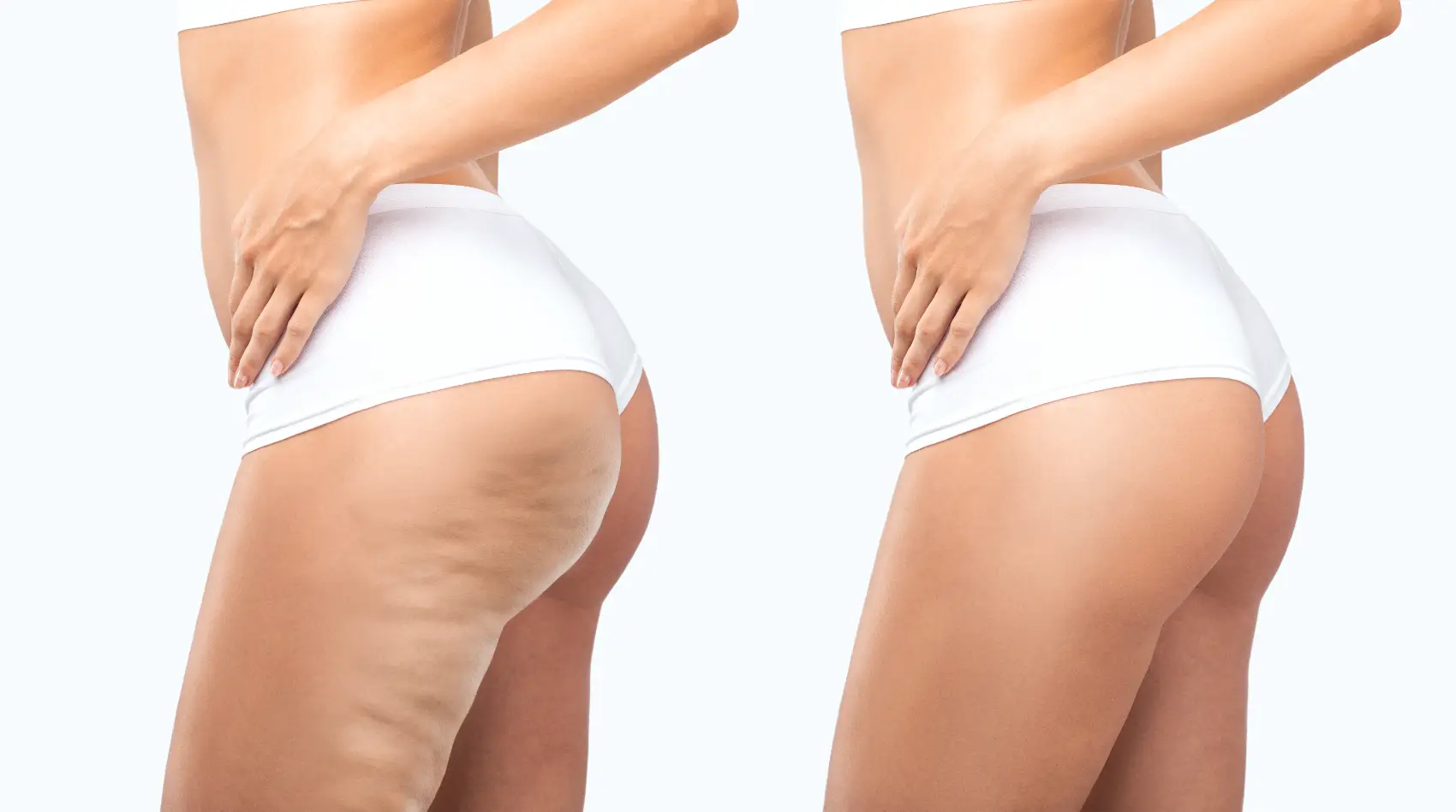 Side-by-side view of thigh before and after treatment showing smoother skin texture