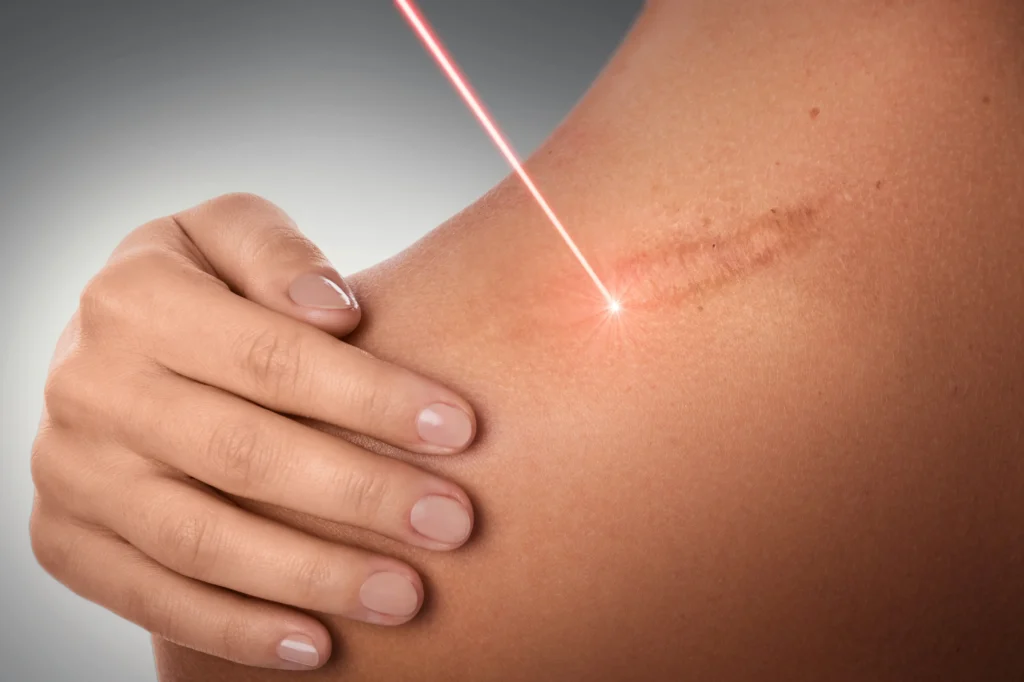 Laser beam targeting scar on skin of arm