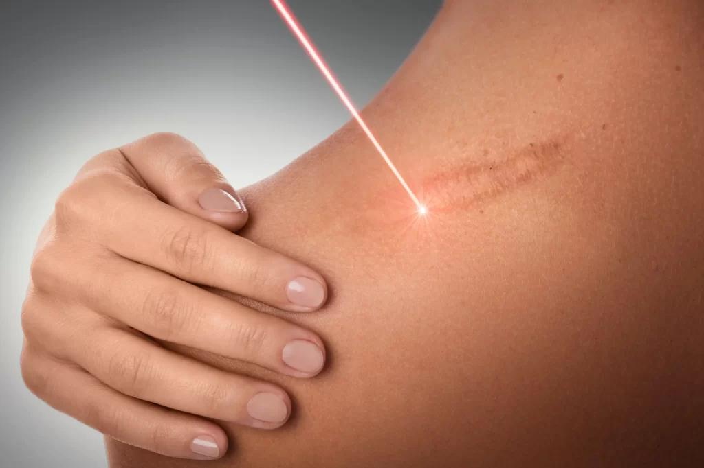 Laser beam targeting scar on skin of arm