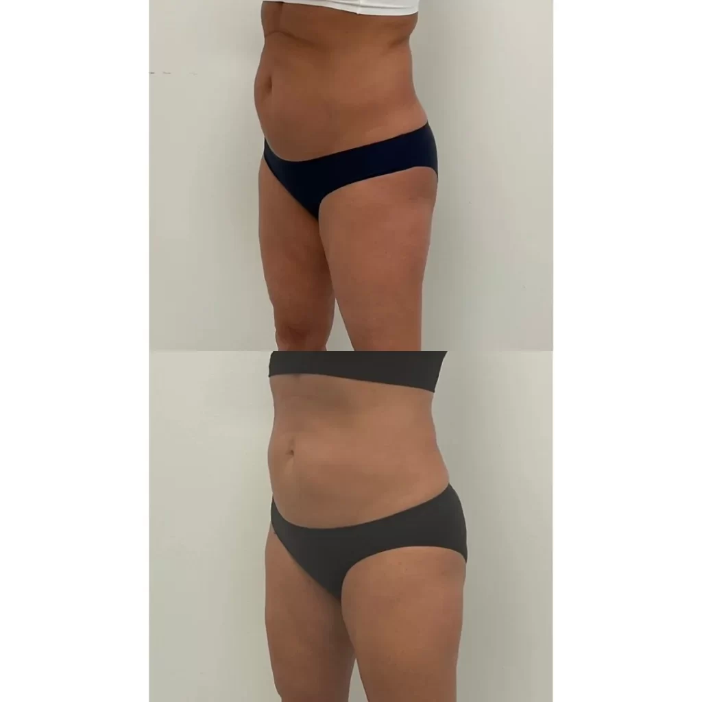 Before and after CoolSculpting Elite fat reduction treatment at Amy Chow, MD, Lee's Summit MO