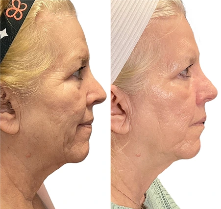 Morpheus8 fractional RF microneedling before and after photo at Amy Chow, MD Rejuvenation Practice