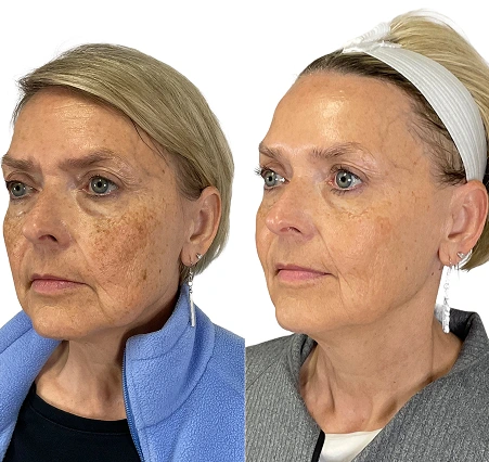 BBL HERO broadband light before and after photo at Amy Chow, MD Rejuvenation Practice, Lee's Summit