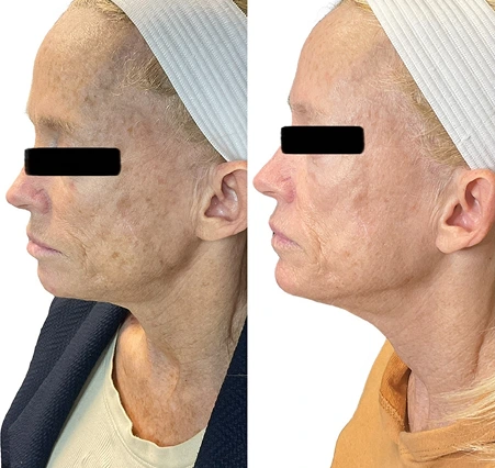 VI Peel chemical peel before and after photo at Amy Chow, MD Rejuvenation Practice, Lee's Summit MO